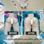 پروتز باسن