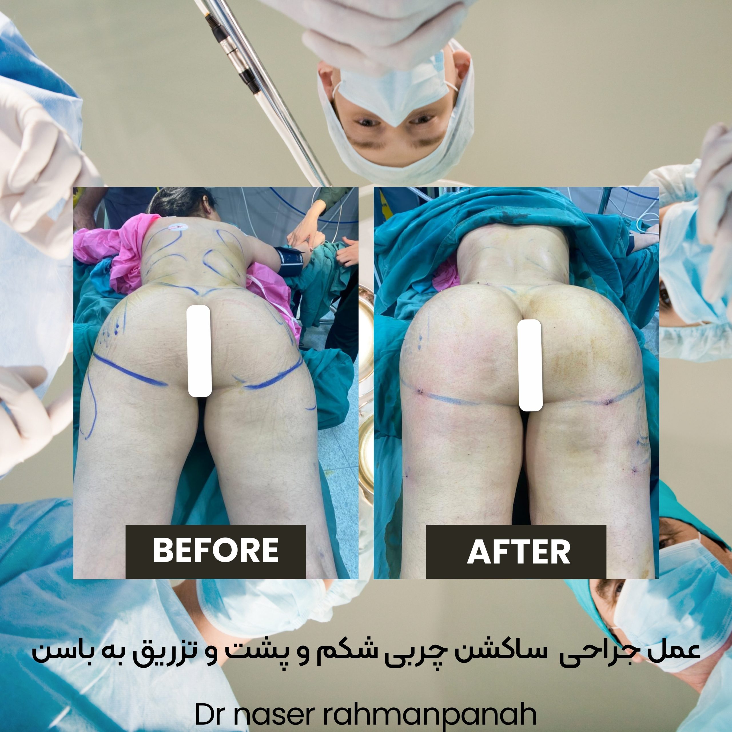 پروتز باسن