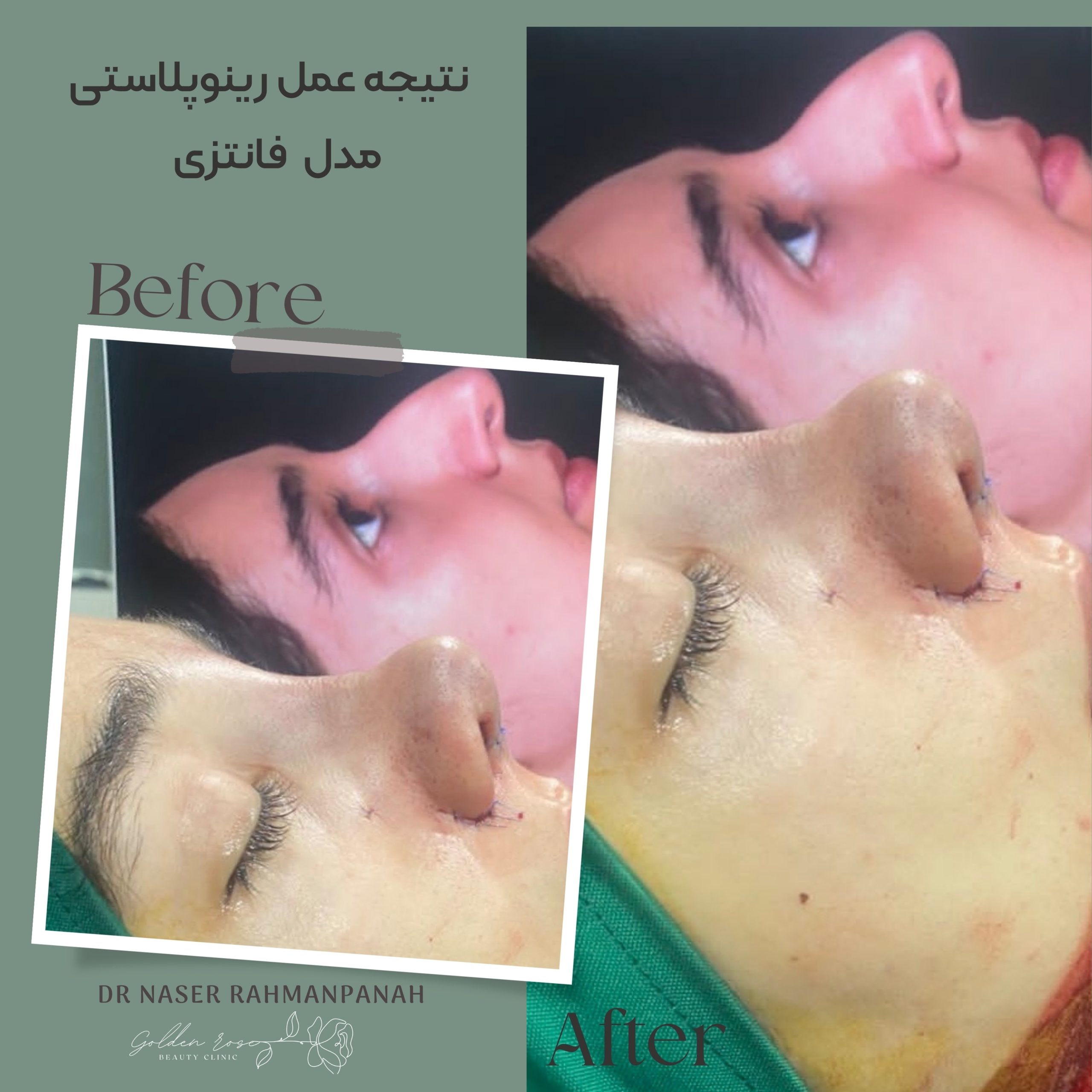 رینوپلاستی