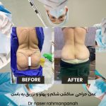 لیپوماتیک
