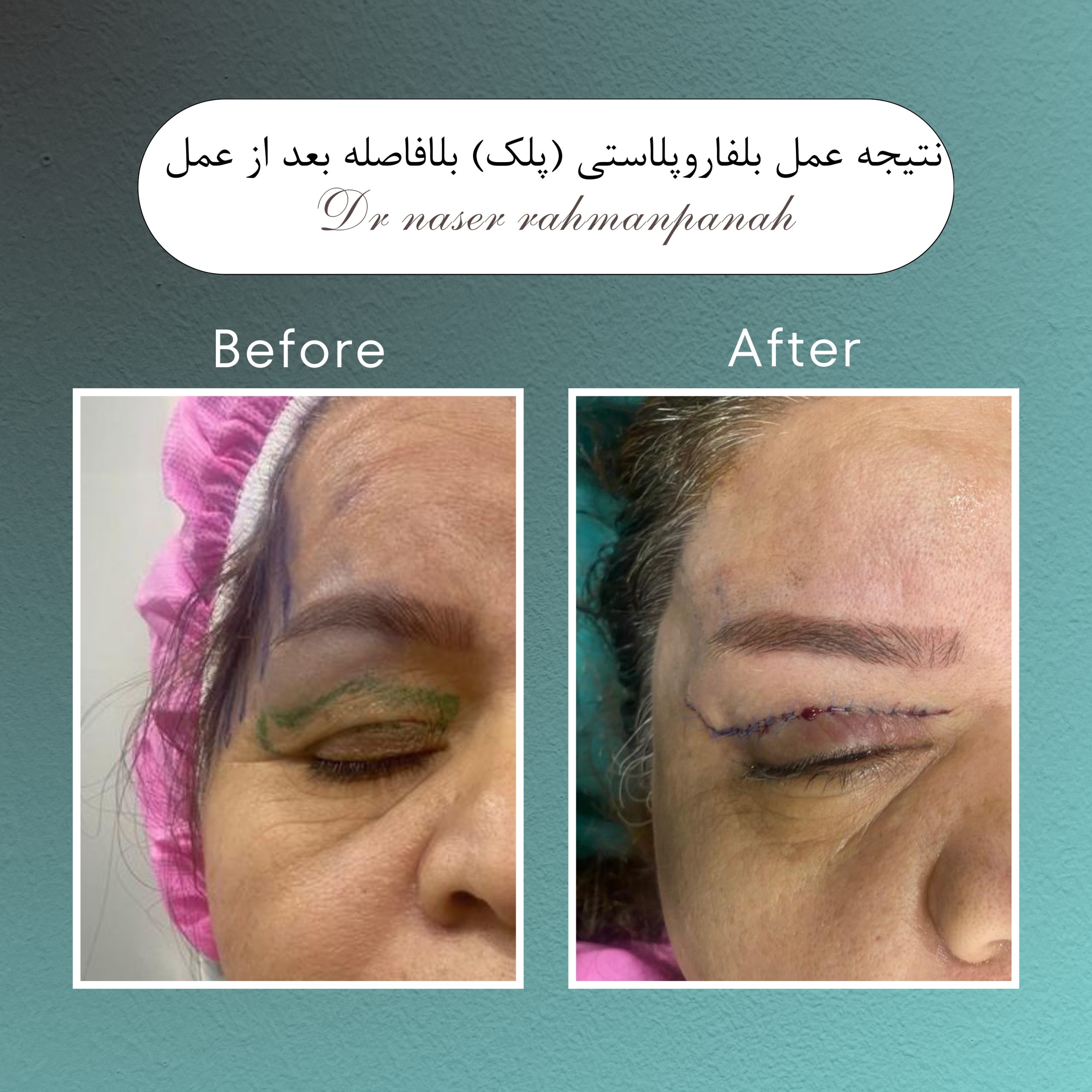 بلفاروپلاستی