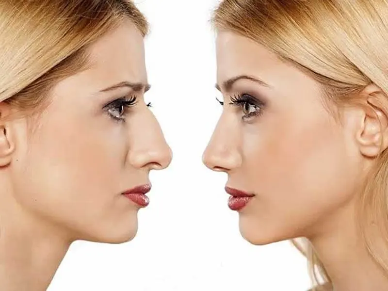 جراحی بینی یا رینوپلاستی