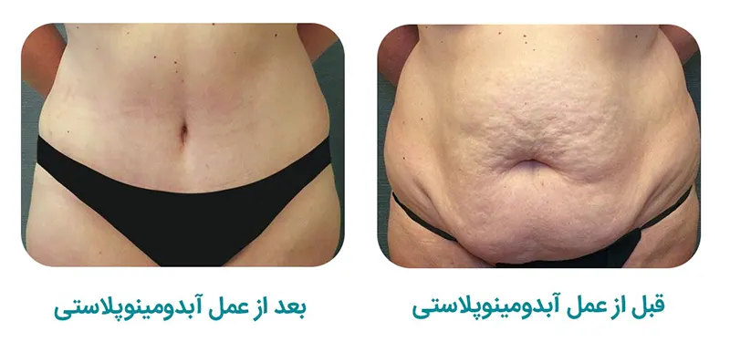 ابدومینوپلاستی /جراحی بادی کانتورینگ