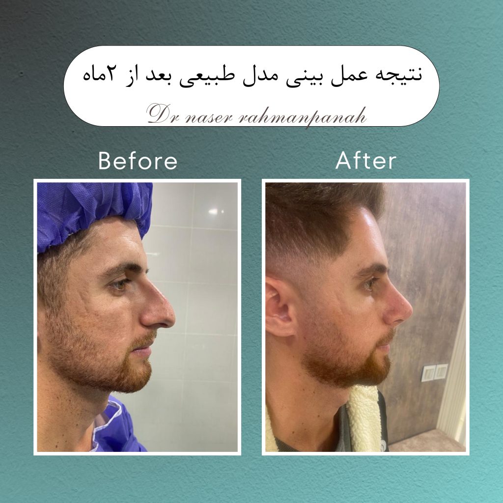 عمل بینی